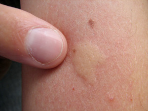 Is your mosquito bite allergic reaction?