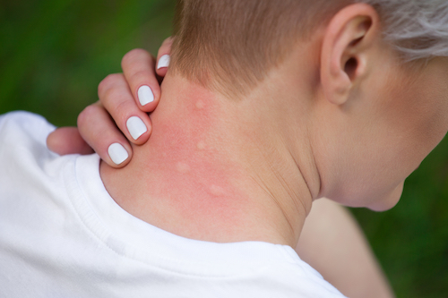 Who's at risk for mosquito bites?